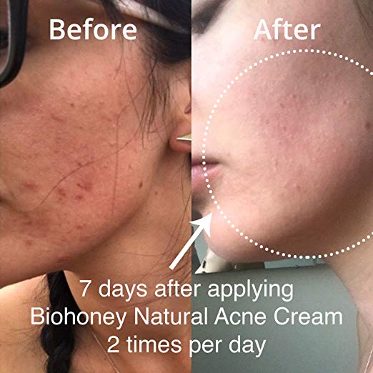 kem trị mụn biohoney
