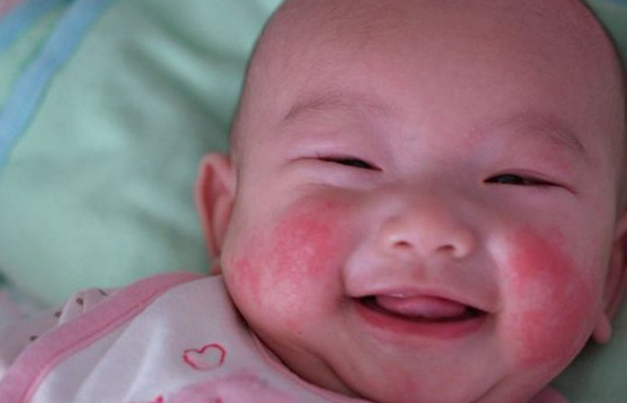 Những cách trị chàm sữa ở trẻ sơ sinh hiệu quả và an toàn được mẹ áp dụng