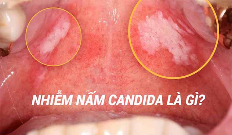 Viêm nhiễm nấm candida là gì