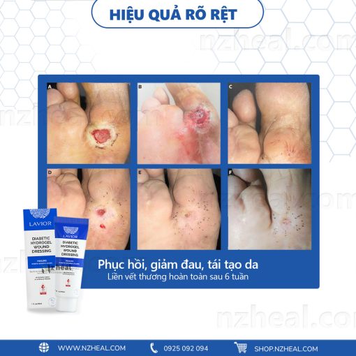 Gel băng vết thương hở LAVIOR Diabetic Hydrogel Wound Dressing (30ml) 2