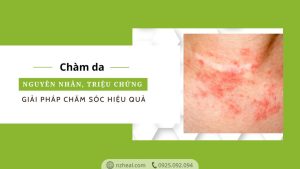 Chàm da: Nguyên nhân, triệu chứng và giải pháp chăm sóc hiệu quả