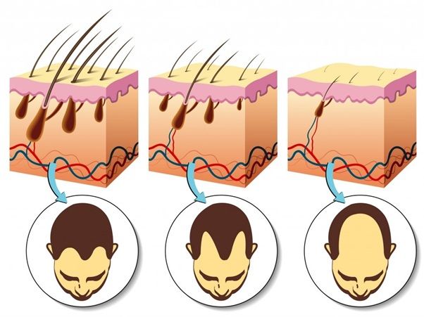 Chặn DHT – chìa khóa ngăn rụng tóc từ gốc với Aotearoa Vitality DHT Blocker